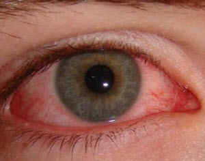 Contact Lens-Induced Acute Red Eye