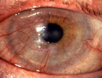Corneal neovascularization