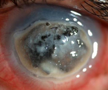 Fungal keratitis